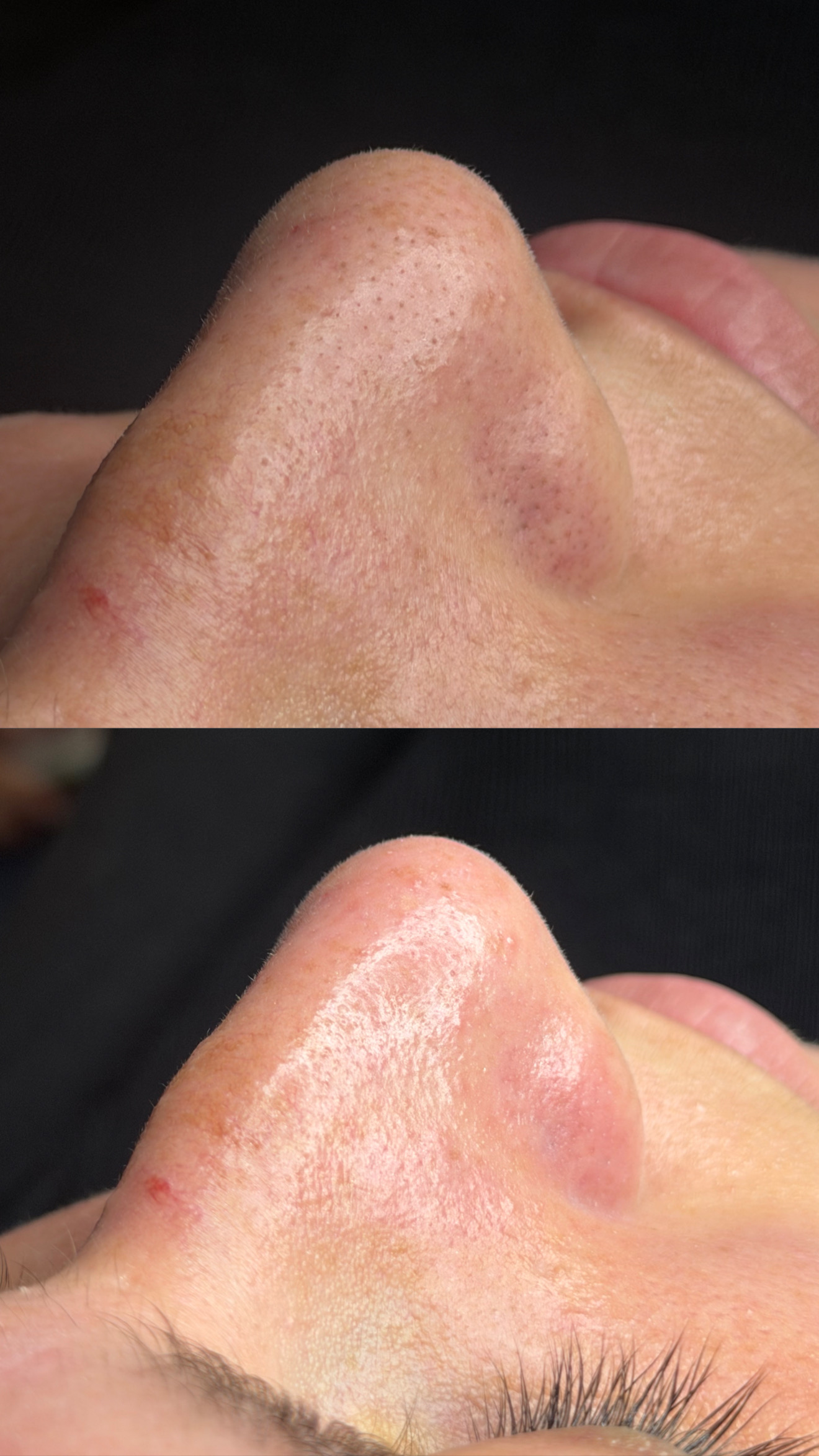 לפני ואחרי טיפול פנים