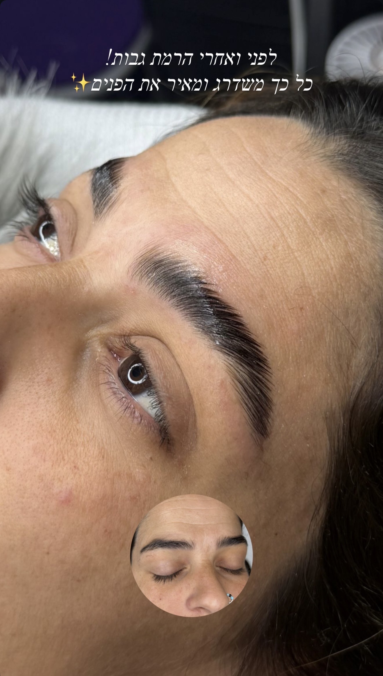 הרמת גבות לפני ואחרי